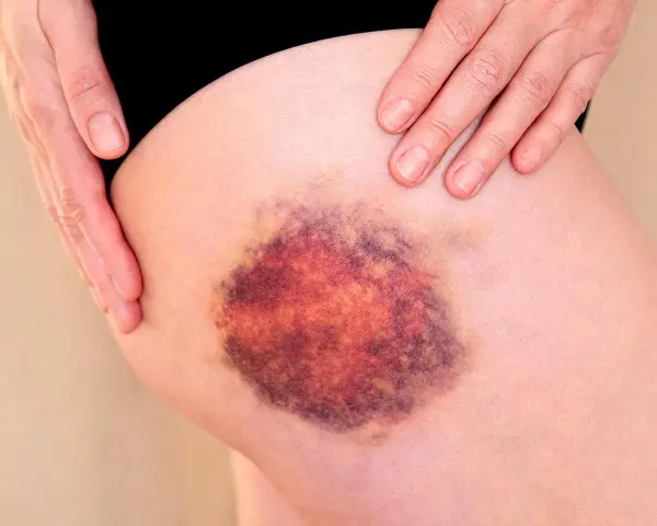 Große, dunkle blaue Flecken auf der Haut des Oberschenkels, die von einer Hand berührt werden.