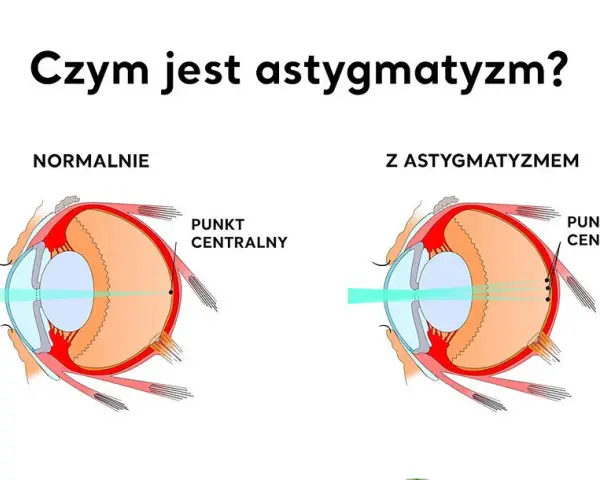 Astygmatyzm: Kiedy do okulisty, a kiedy do optometrysty?