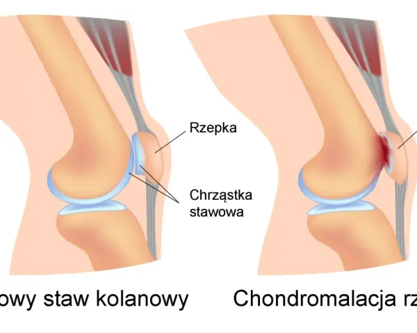 Porównanie zdrowego stawu kolanowego z chondromalacją rzepki, gdzie chrząstka stawowa jest uszkodzona.