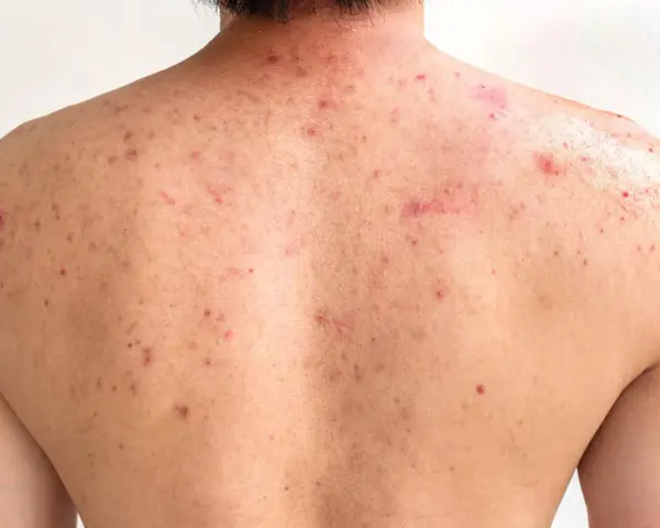 Espalda con acné, mostrando cómo quitar los granos de la espalda.