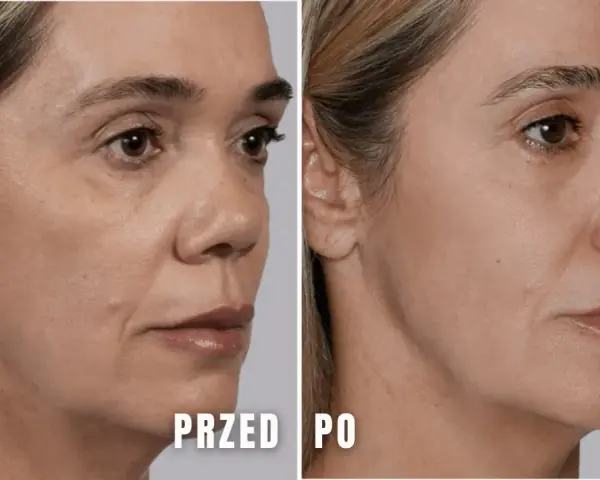 Przed i po zabiegu z użyciem kwasu polimlekowego. Skóra twarzy wygładzona, zmarszczki zredukowane, a owal twarzy poprawiony.