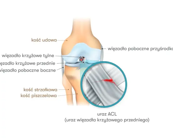 Anatomia kolana z zaznaczonym urazem ACL (przedniego więzadła krzyżowego). Widoczny pęknięty włókna więzadła.