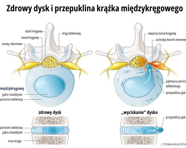Pęknięcie pierścienia włóknistego objawy: przepuklina jądra miażdżystego uciska korzeń nerwowy, powodując zwężenie kanału kręgowego.