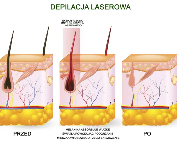 Ilustracja pokazuje laserowe usuwanie wąsika: przed zabiegiem, ekspozycję na laser i efekt po.