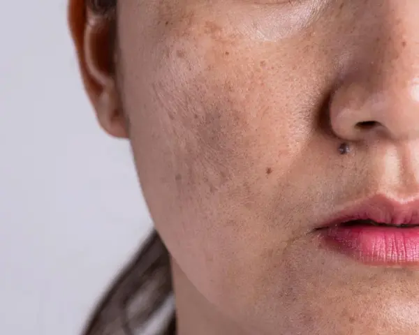 Primer plano de una cara con melasma y un pequeño lunar sobre el labio superior, simulando un bigote.