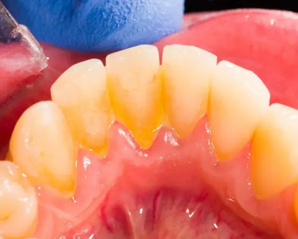 Widoczne żółte przebarwienia i osad, czyli kamień nazębny, przy linii dziąseł. Dentyści usuwają go specjalnymi narzędziami.