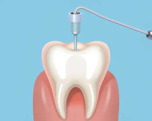 Ilustracja zęba z narzędziem dentystycznym w środku.
