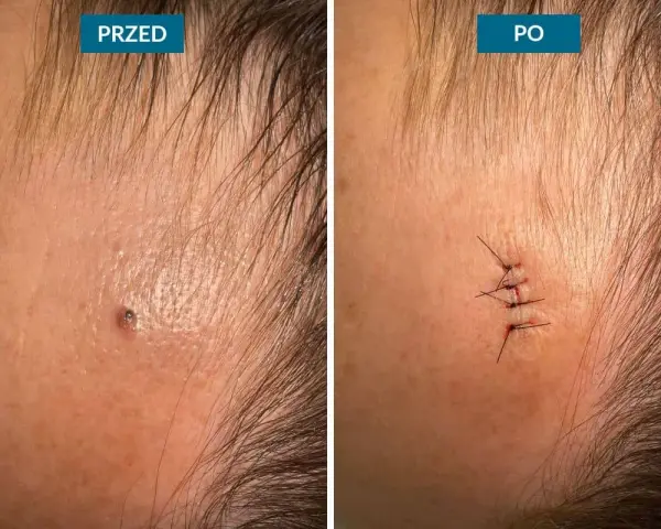 Przed i po zabiegu usuwania narośli skórnych. Widoczne blizny po chirurgicznym usunięciu zmiany.
