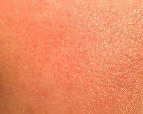 Pelle arrossata e secca, con piccole scaglie visibili, tipica di un'irritazione da retinolo.