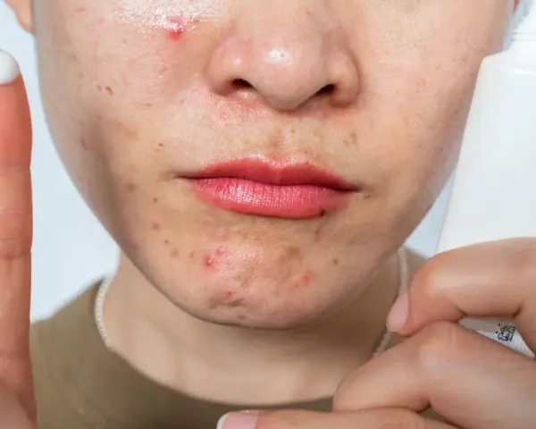 A person's face shows acne and redness, possibly from retinol burn. A finger with cream and a tube of skincare product are visible.