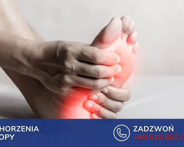 Dłoń uciska bolesną stopę, sugerując problem ze stopą Mortona.