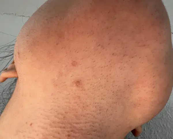 Skóra po depilacji laserowej z widocznymi odrastającymi włoskami. Wyjaśnienie, dlaczego włosy po depilacji laserowej odrastają, tkwi w cyklu wzrostu włosa.