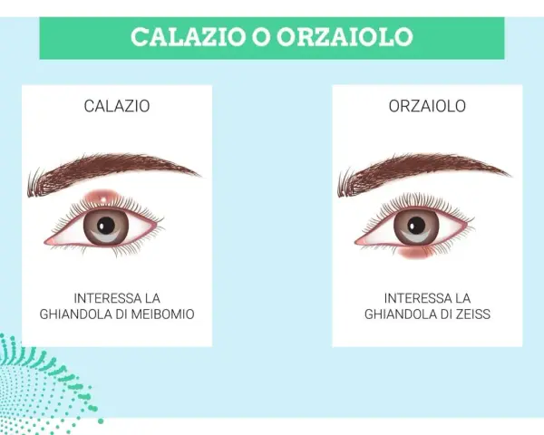 Illustrazione che confronta calazio e orzaiolo. Il calazio interessa la ghiandola di Meibomio, causando un gonfiore.