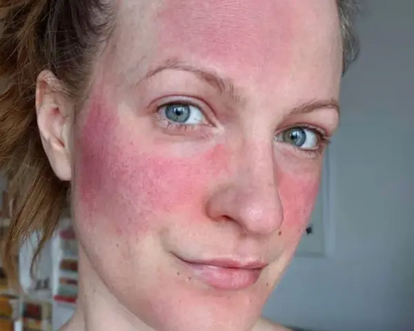 Frau mit stark geröteter Haut im Gesicht, möglicherweise Rosacea. Die Anwendung von Retinol kann hier eine Rolle spielen.