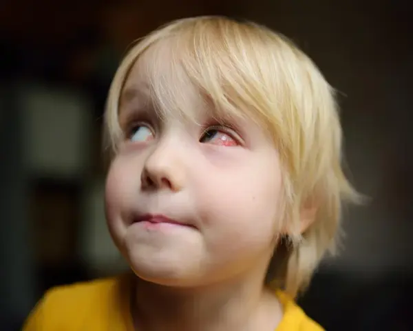 Mały chłopiec z blond włosami ma zaczerwienione, spuchnięte oko.