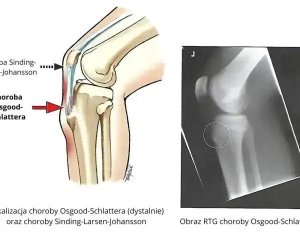 Ilustracja anatomiczna kolana z zaznaczoną chorobą Osgooda-Schlattera i RTG potwierdzające tę chorobę. Rzepka typu 2.