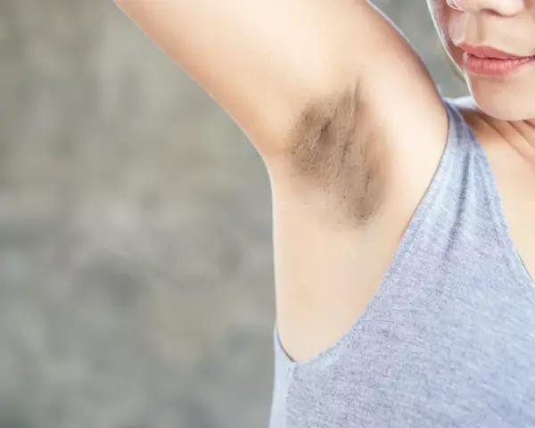 Primer plano de una axila con manchas oscuras y vello visible.
