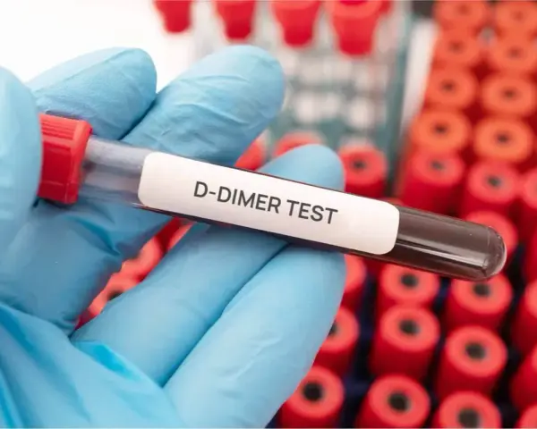 Rękawiczka trzyma probówkę z oznaczeniem "D-DIMER TEST". W tle widać wiele innych probówek. Podwyższone d-dimery mogą wskazywać na zakrzepicę.