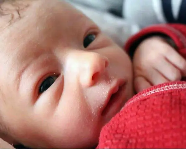 Primo piano del viso di un neonato con crosta lattea. La sua manina è appoggiata su una coperta rossa.