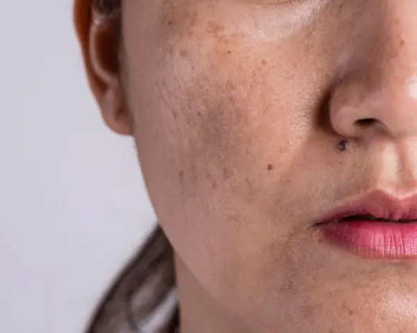 Nahaufnahme eines Gesichts mit sichtbarem Melasma über der Oberlippe und dunklen Flecken.