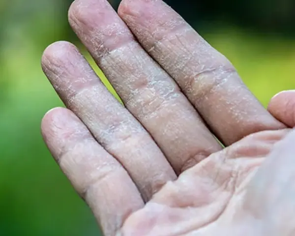 Dedos con piel seca y escamosa, similar a ampollas en los pies por sudor.
