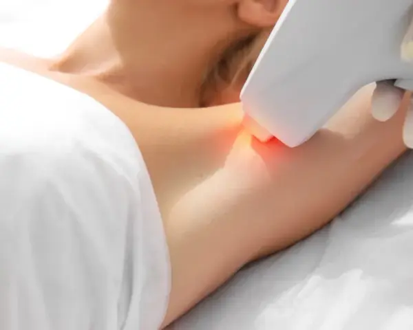 Epilacja laserowa co to – skuteczna metoda trwałego usuwania włosów