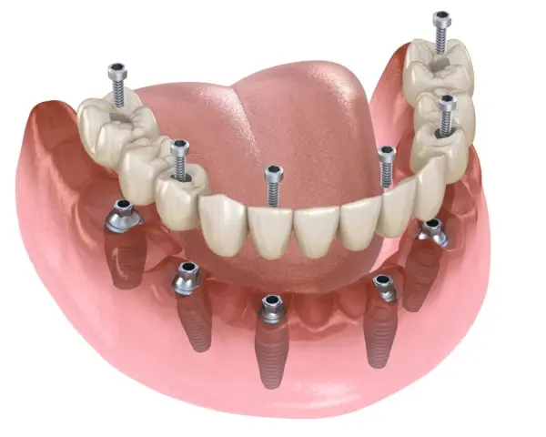 Ile kosztuje implant zęba? Pełny cennik i jak mądrze zaplanować budżet