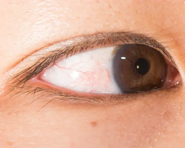 Occhi marroni con sclera arrossata e piccole mosche bianche visibili.