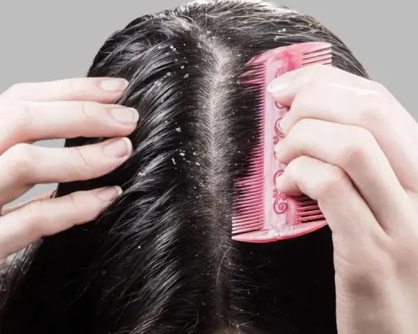 Hände kämmen dunkles Haar, das sichtbare Schuppen zeigt. Die trockene Kopfhaut ist deutlich zu erkennen.