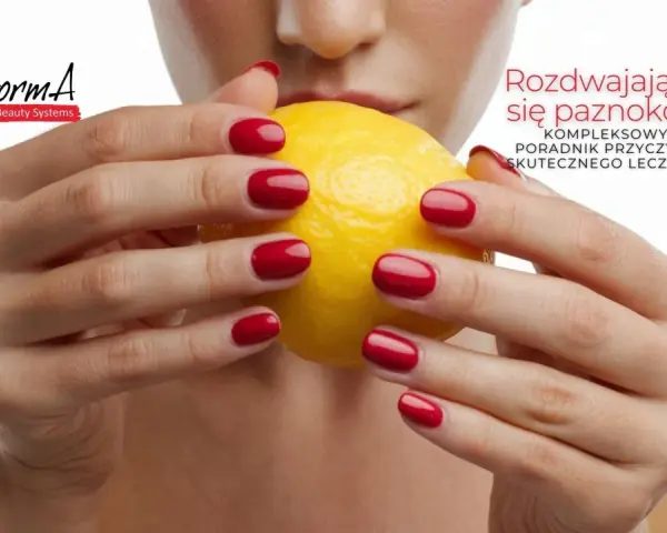 Dłonie z czerwonymi paznokciami trzymają cytrynę. Tekst informuje o rozdwajaniu się paznokci i sposobach leczenia.