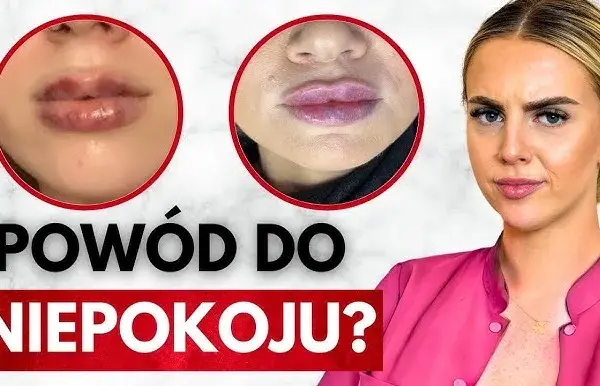Kiedy schodzi opuchlizna po kwasie hialuronowym? Sprawdź, co robić