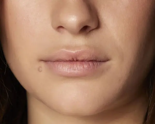 Labios con una pequeña marca, buscando un remedio casero para labios cortados.