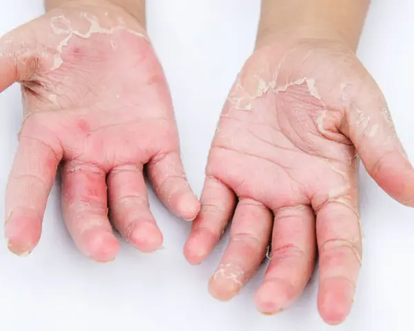 Mani con evidente desquamazione della pelle, arrossamento e secchezza. La pelle appare irritata e screpolata.