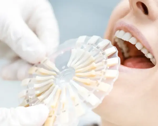 Usta pacjentki z białymi zębami, dentysta porównuje odcień zębów z paletą kolorów. Po wybielaniu zębów zalecana jest biała dieta.