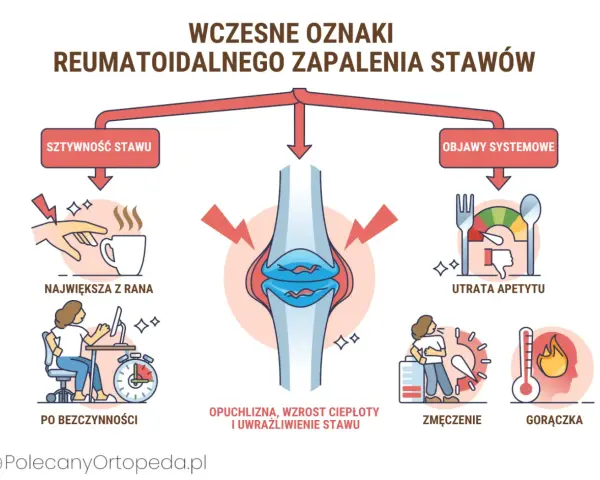 Wczesne oznaki reumatoidalnego zapalenia stawów: sztywność stawu, opuchlizna, zmęczenie, gorączka, utrata apetytu.