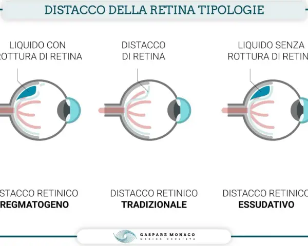 Illustrazione mostra tre tipi di distacco della retina: con rottura, tradizionale e essudativo. Il buco nella retina è evidenziato in uno dei casi.