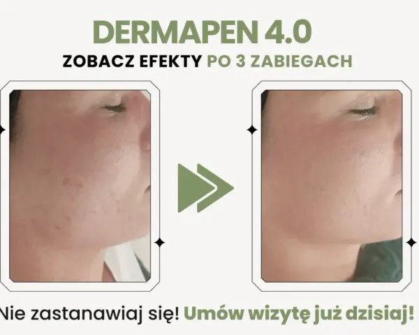 Dermapen 4.0 na co? Zobacz efekty po 3 zabiegach: skóra wygładzona, bez niedoskonałości. Umów wizytę!