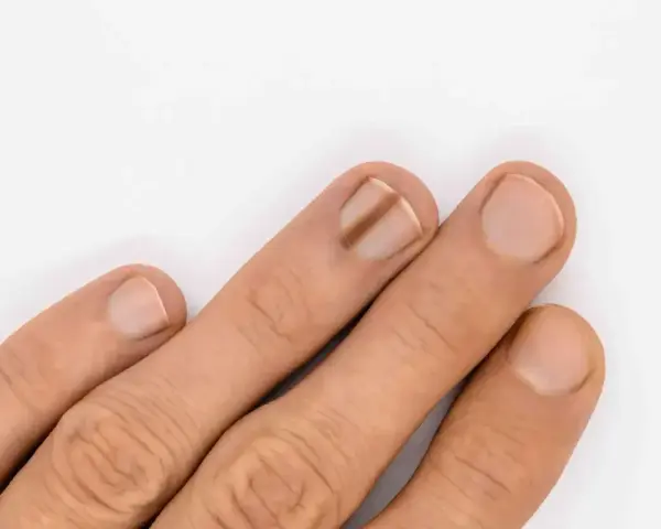 Dłoń z widocznymi czarnymi kreskami na paznokciach, sugerującymi zmianę pigmentacyjną.