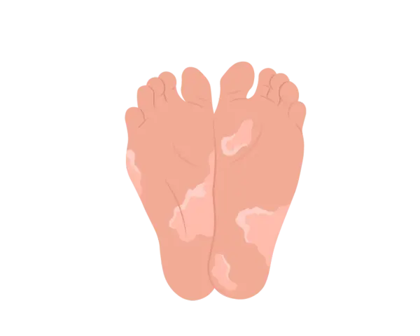 Pieds avec des zones dépigmentées, soulevant la question : pourquoi la peau de mes pieds s'enlève ?