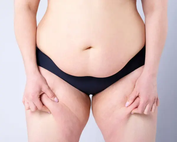 Persona se pellizca la piel de los muslos, mostrando la celulitis. Pensando en ejercicios abdomen bajo para mejorar.