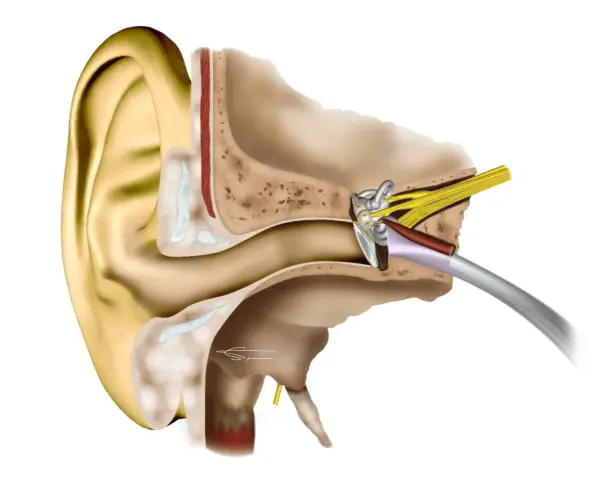 Coupe anatomique de l'oreille montrant les structures internes, y compris le tympan et les osselets, qui peuvent être affectés par une distorsion sonore oreille.