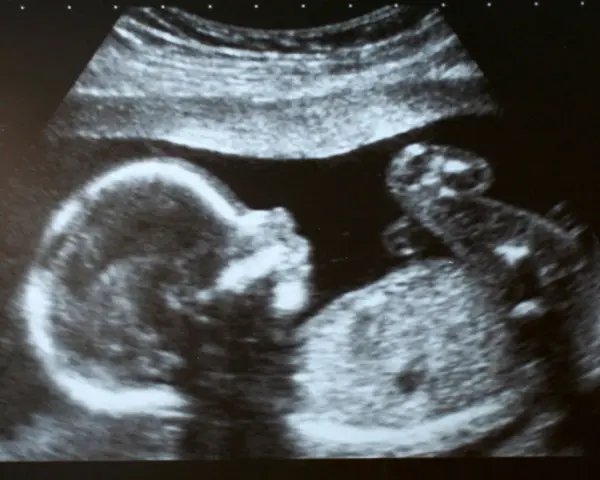 Ultraschallbild eines Babys, das sich im Mutterleib entwickelt. Ein kleiner Arm ist zu sehen, was auf einen ultraschall jungen hindeutet.