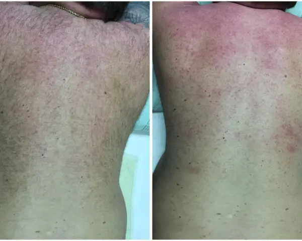 Comparación de la espalda antes y después de un intento de como depilarse la espalda uno mismo. La imagen de la derecha muestra irritación y enrojecimiento.