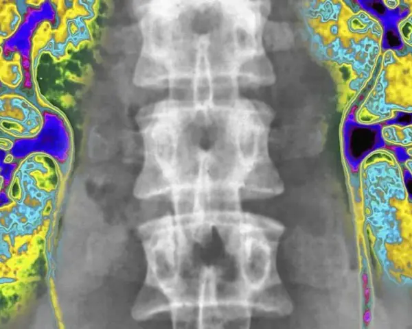 Kolorowa scyntygrafia kości pokazuje kręgosłup i obszary o zwiększonej aktywności metabolicznej, sugerujące potencjalne problemy.