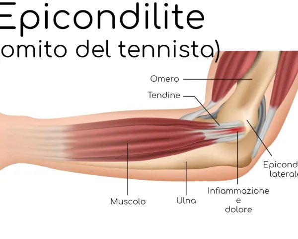 Illustrazione anatomica del gomito del tennista, evidenziando infiammazione e dolore all'epicondilo laterale.