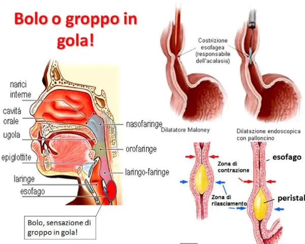 Illustrazione anatomica della gola e dell'esofago, che mostra come un bolo possa causare la sensazione di sentire qualcosa in gola.