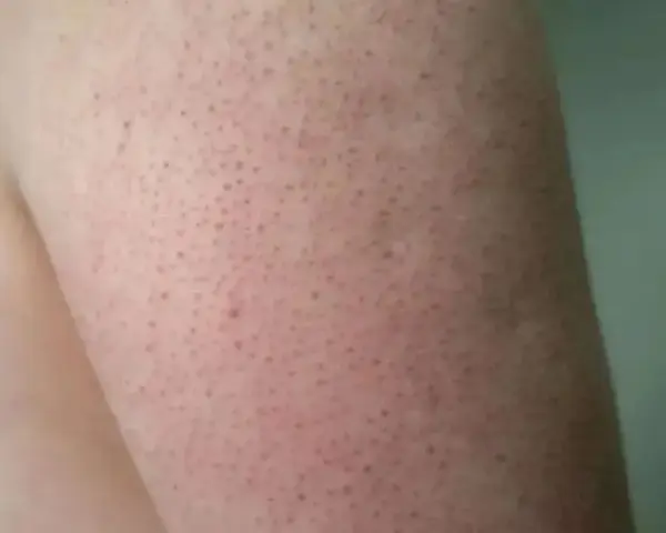 Piel de fresa con pequeños puntos oscuros, como si fueran semillas, en un brazo.
