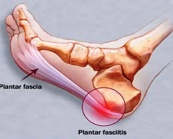 Illustration av fotens anatomi som visar plantar fascia och smärta vid plantar fasciitis.
