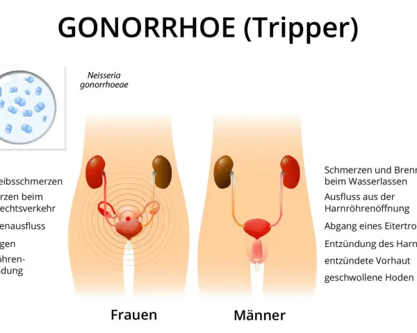 Darstellung von Gonorrhoe (Tripper) bei Frauen und Männern mit Symptomen wie Unterleibsschmerzen, Ausfluss und Entzündungen.