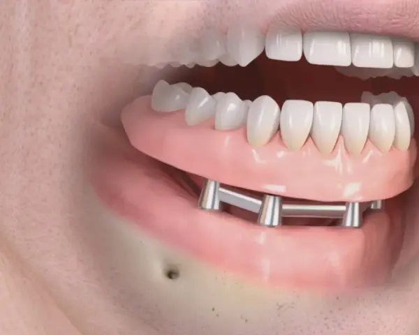 Implant zębowy: Bez bólu i strachu? Poznaj 5 etapów zabiegu